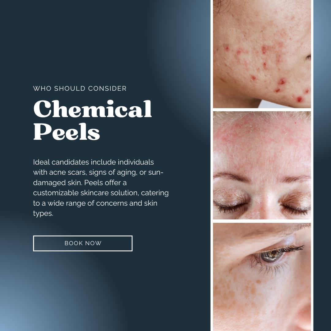 30 Chemical Peel Social Media Templates | Skincare Marketing Canva Pack for Estheticians & Med Spas - Social Canvas